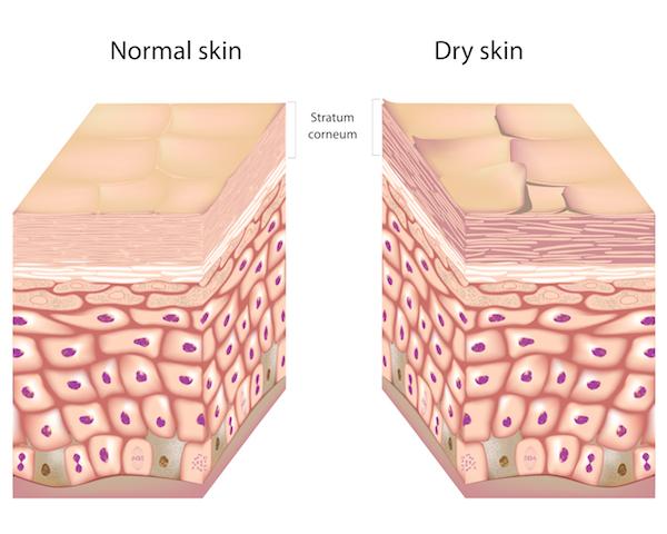 キメの整った皮膚とキメの乱れた皮膚